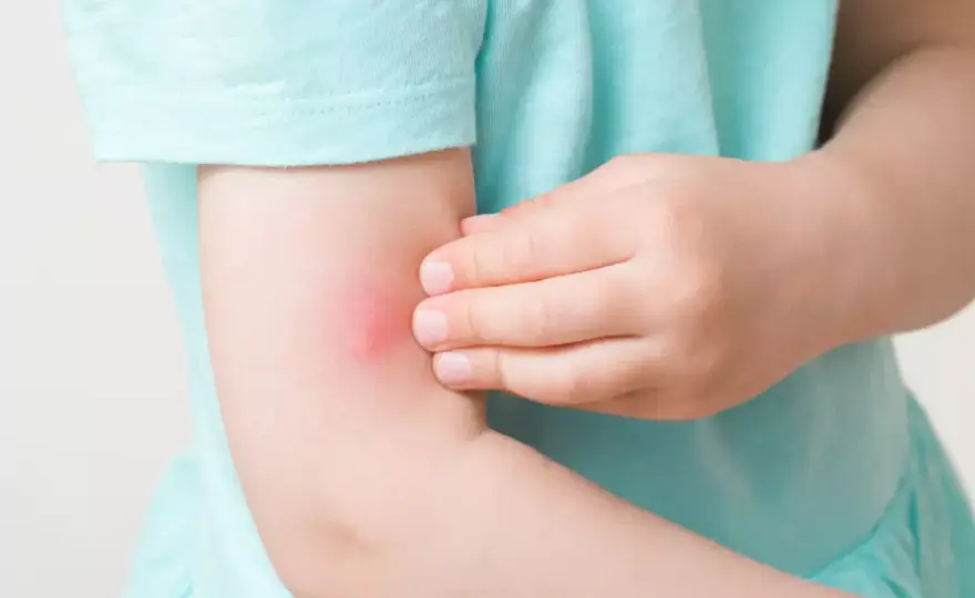 Myggbett som svullnar mycket - så skiljer du allergi och infektion