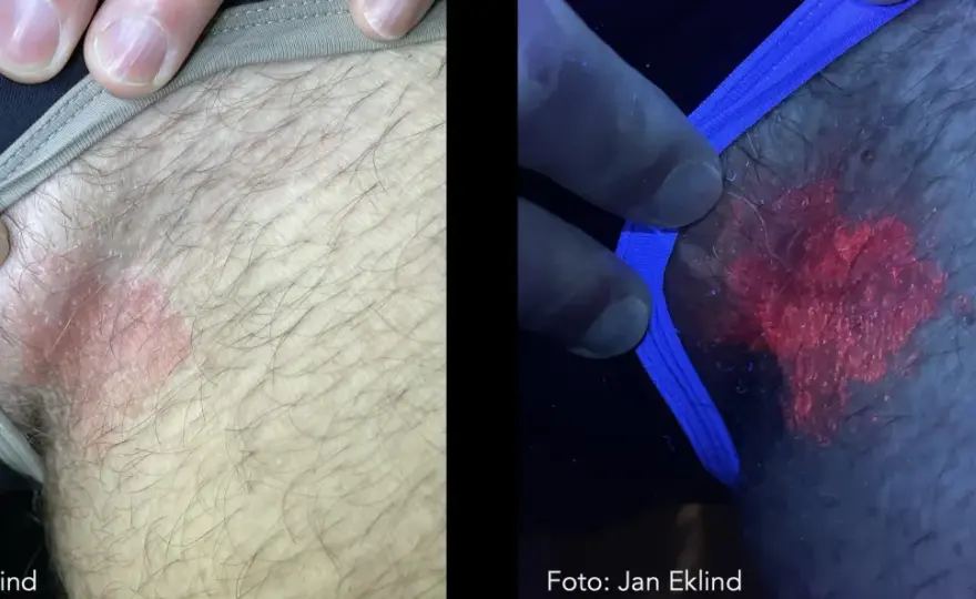 Svamp på pungen? Så skiljer du svamp från eksem