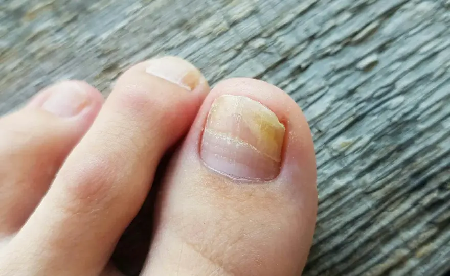 Nagelsvamp - så känner du igen den och när du ska söka vård