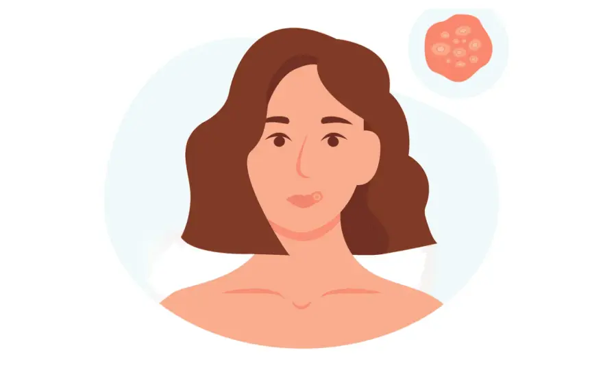 Genital herpes - symtom, smitta och vad som faktiskt hjälper