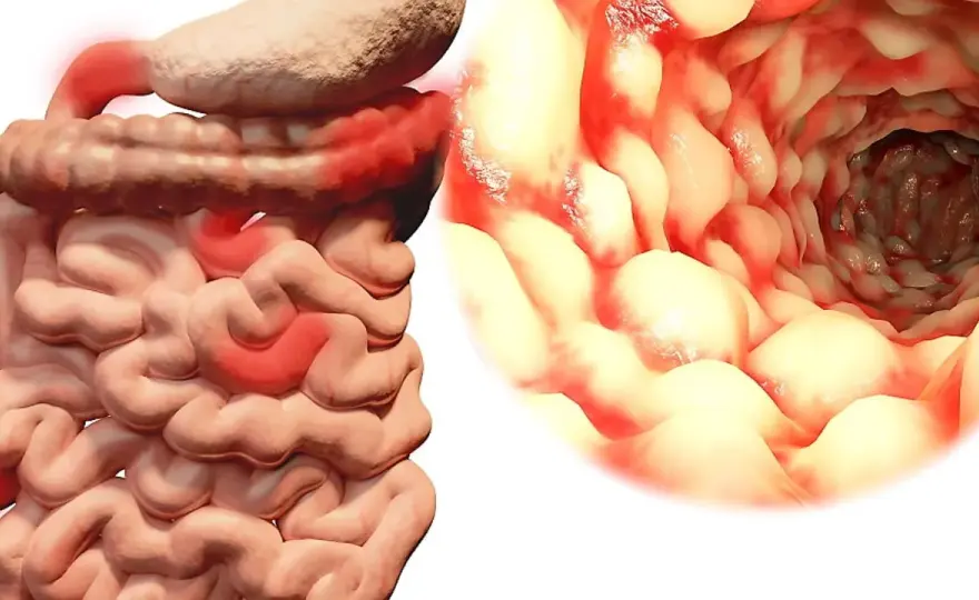 Crohns sjukdom - symtom, utredning och behandling
