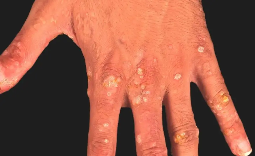Epidermodysplasia verruciformis - symtom, diagnos och behandling