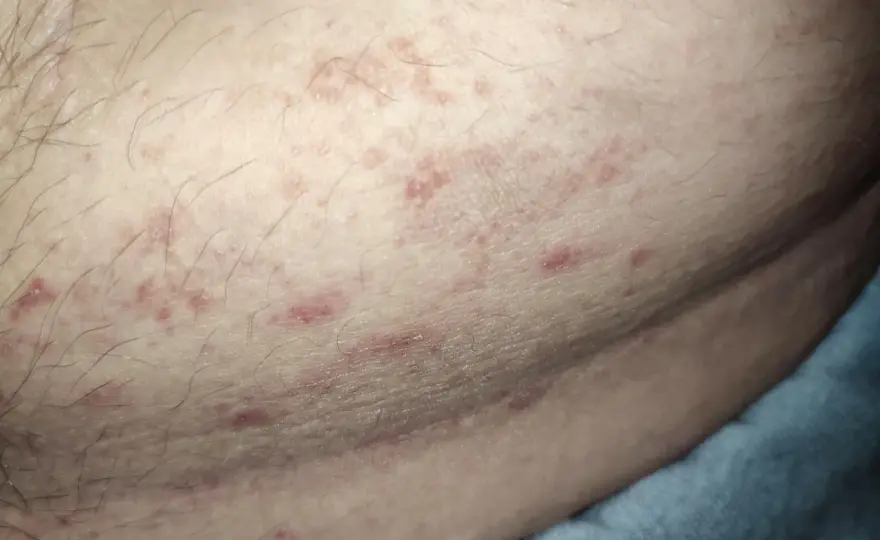 Utslag vid hiv - så ser det ut och när du ska testa dig