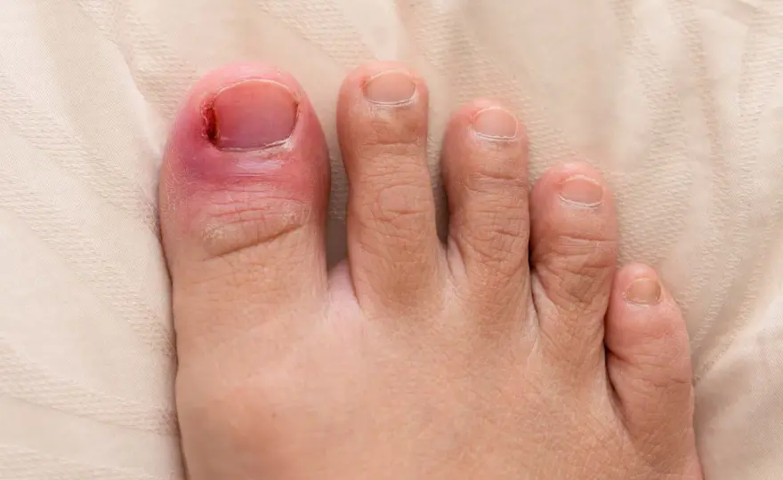 Nageltrång behandling - vad hjälper hemma och när behövs operation?