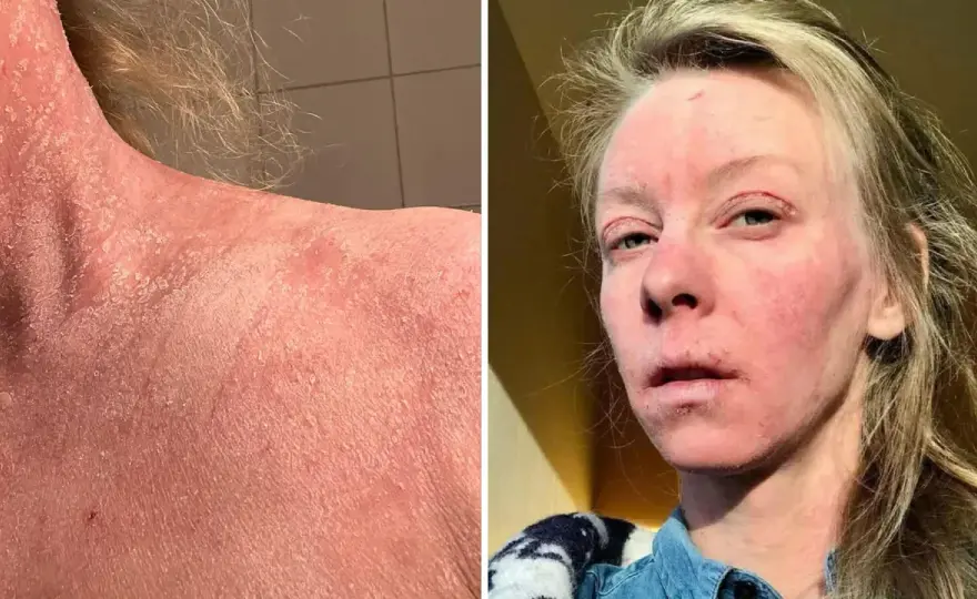 Kortison och alkohol - när bör du vara försiktig?