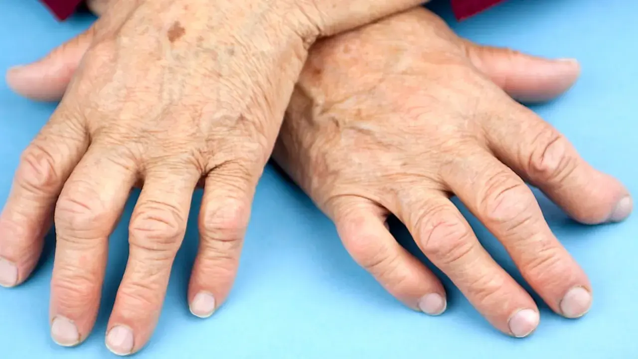 Äldre händer med synliga åderbråck och pigmentfläckar, som kan indikera behov av ny medicin mot reumatism.
