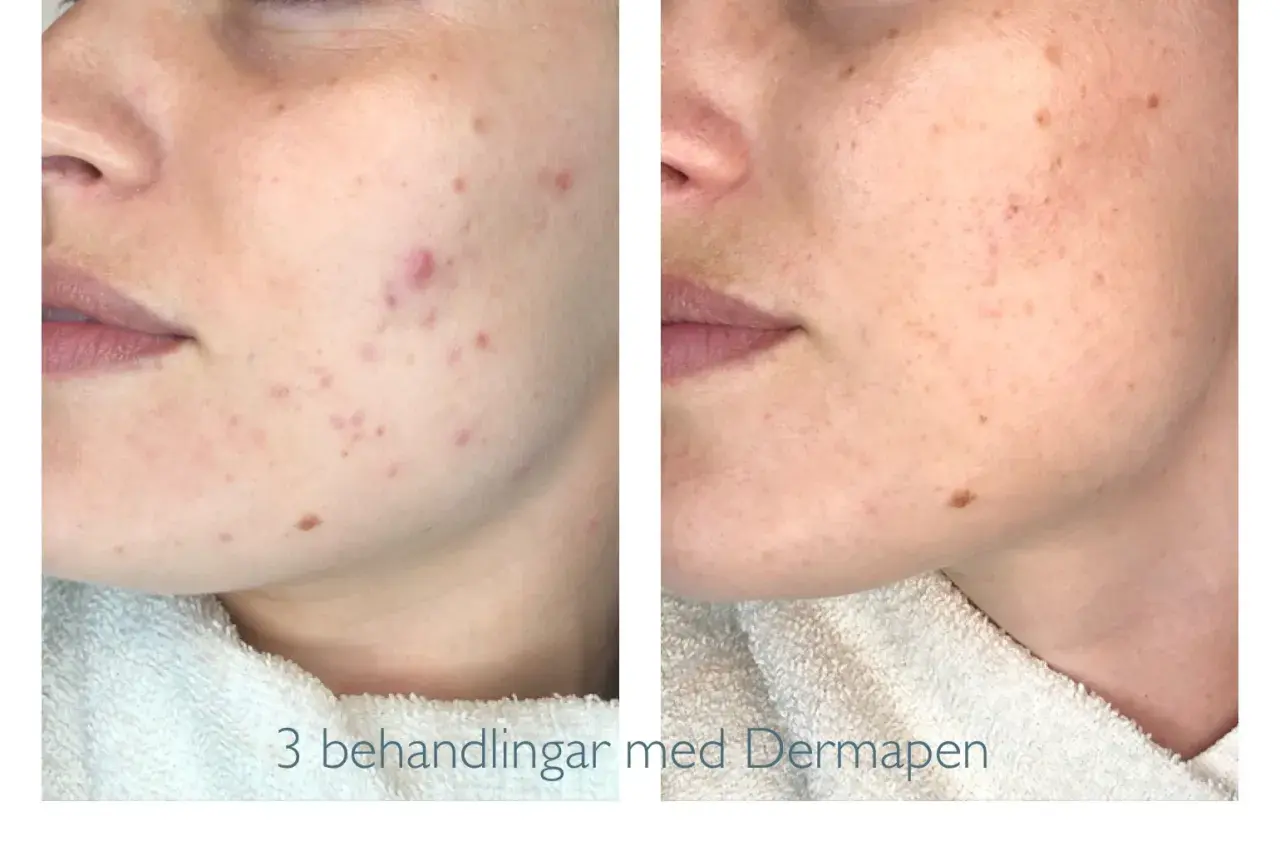 Före och efter-bilder visar hur Dermapen behandlat acneärr och förbättrat hudens textur.