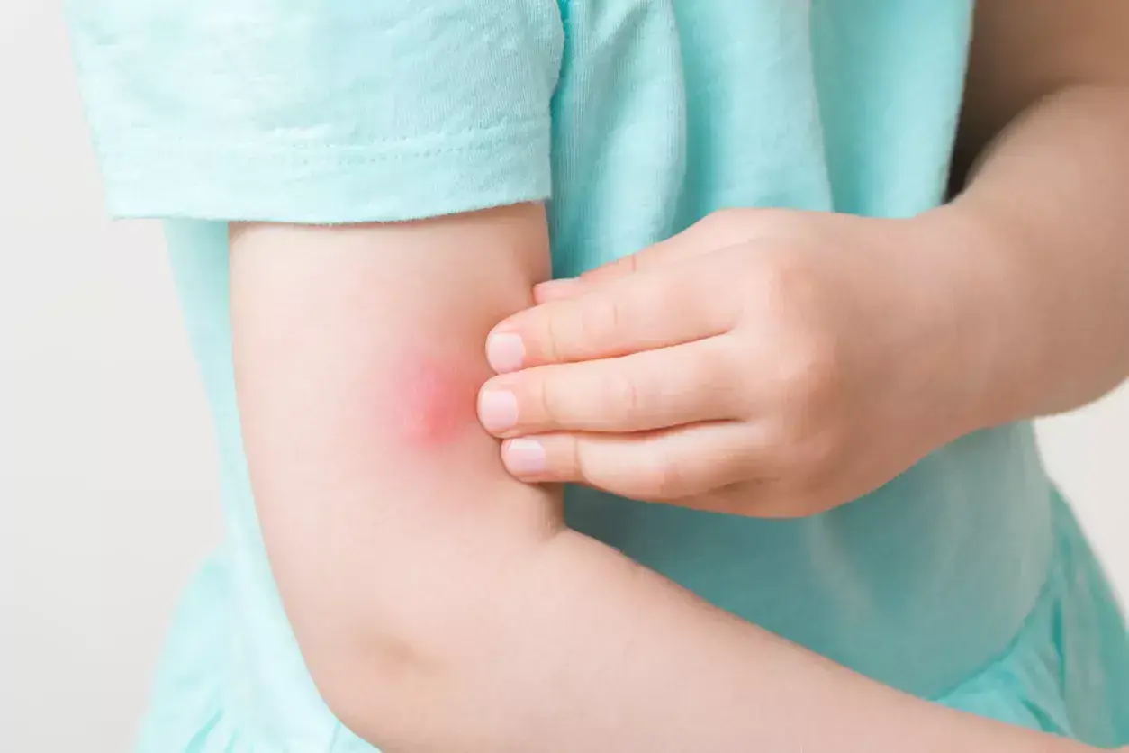 Barnets arm med ett rött, svullet myggbett. Barnet verkar vara allergisk mot myggbett och kliar på bettet.