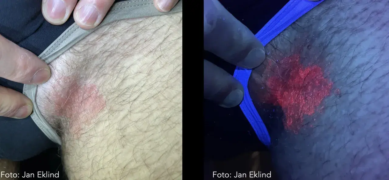 Hudutslag på ljumsken, synligt i vanligt ljus och under UV-ljus som visar en rödaktig svamp pung.