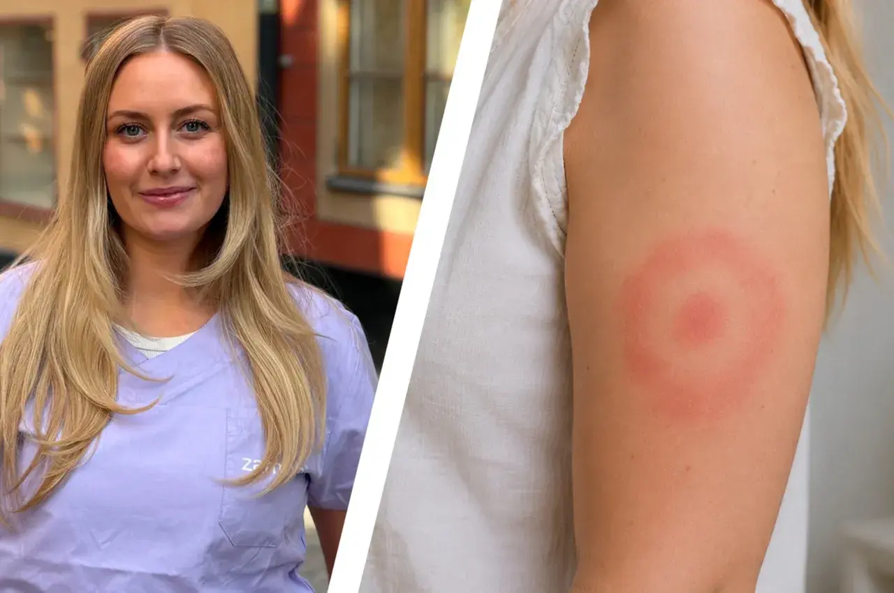 En kvinna med blont hår visar upp ett utslag på armen, ett tydligt tecken på borrelia.