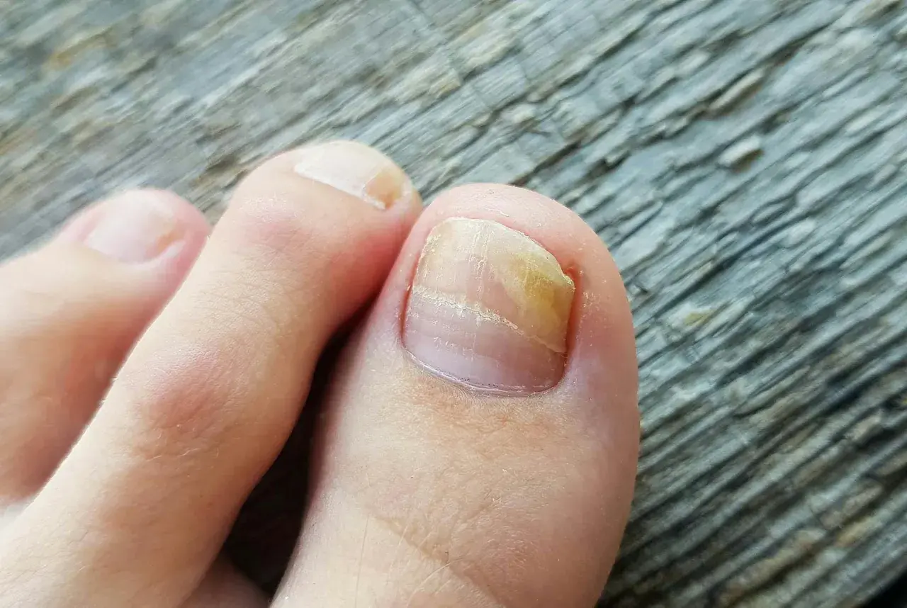 Tånagel med gulaktig missfärgning och förtjockning, tecken på nagelsvamp. Läs mer på 1177.