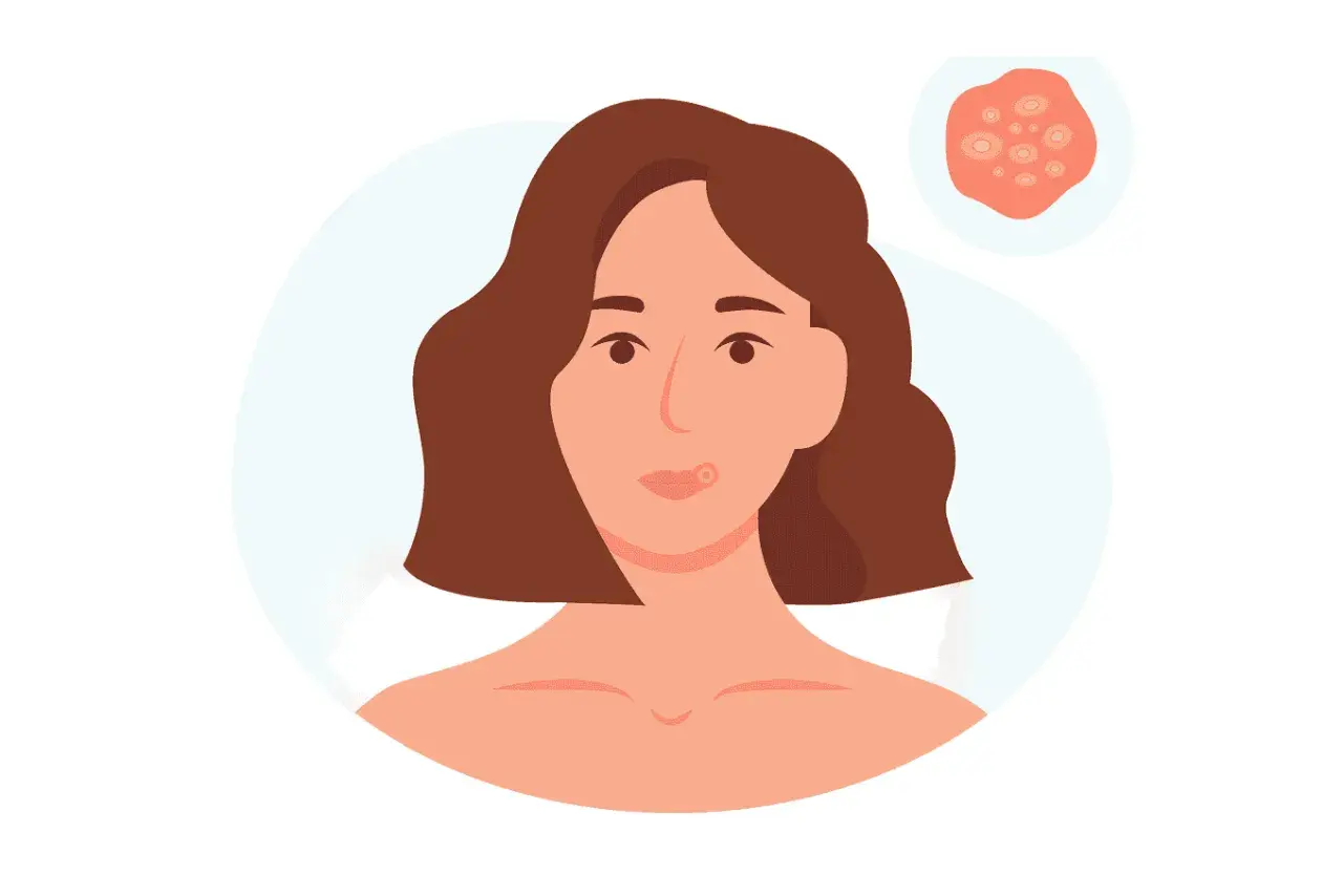 Illustration av en kvinna med en blåsa på läppen, som kan likna herpes. En närbild av blåsor visas i en cirkel.