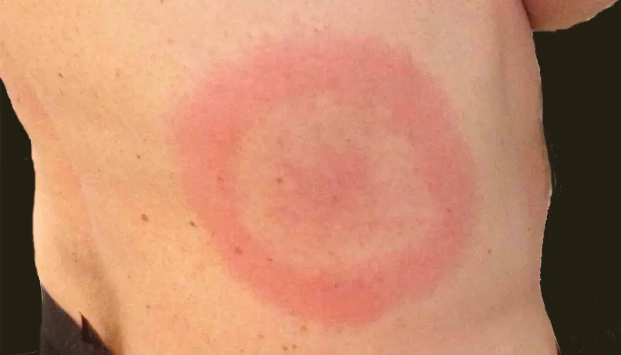 Rött, cirkulärt utslag på huden, liknande ett utslag i ansiktet som kan uppstå vid exempelvis borrelia.