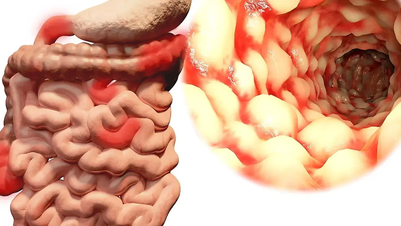 Illustration av inflammerade tarmar, som visar symtom på crohns sjukdom. En inre vy av tarmen visar rodnad och svullnad.