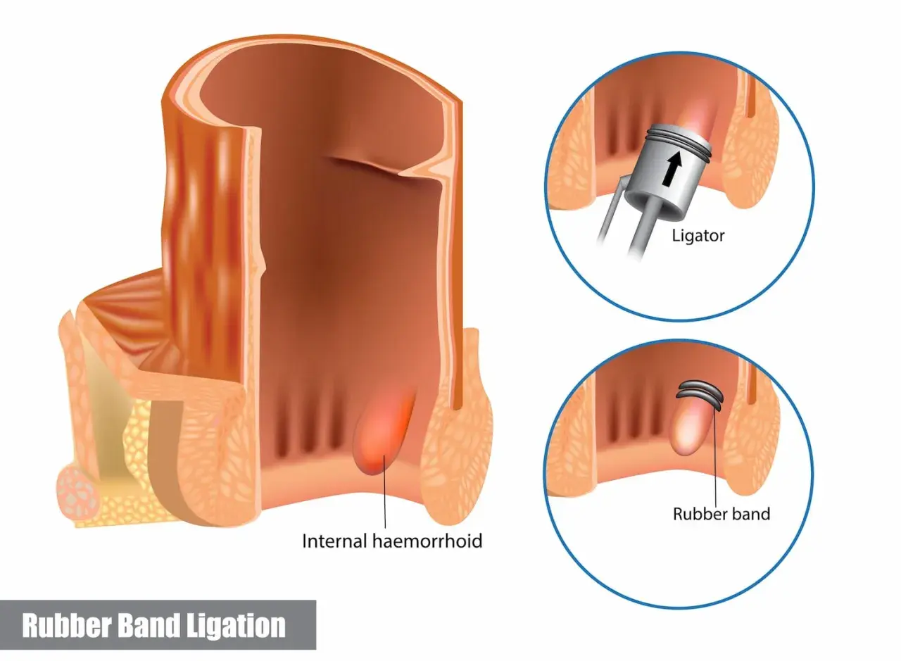 Illustration visar hur hemorrojder ser ut och hur de behandlas med gummibandsligering. En intern hemorrojd visas, samt hur en ligator applicerar ett gummiband.