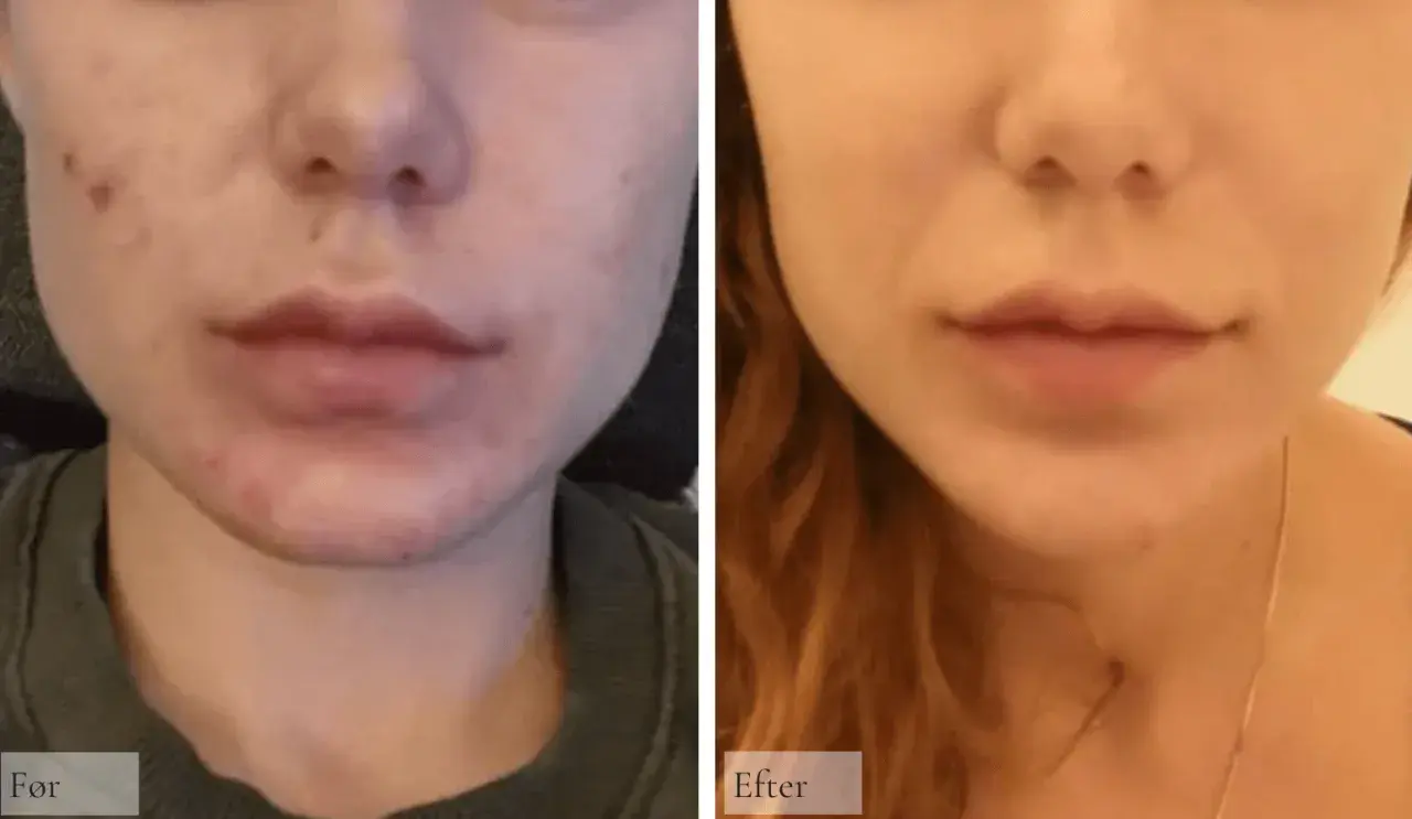 Före och efterbilder visar en minskning av akne och postinflammatorisk hyperpigmentering runt munnen.