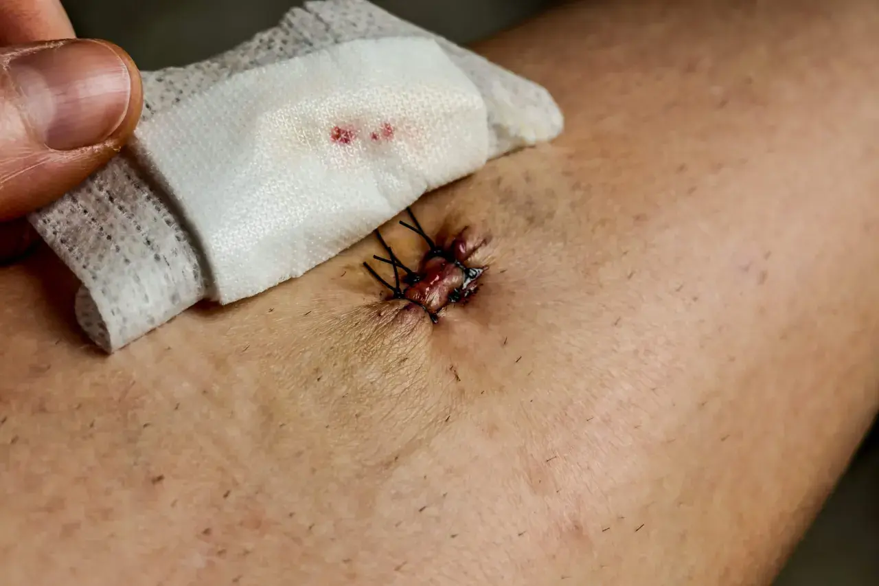 En tumme lyfter en kompress från ett sår med stygn. För att såret ska läka fint måste man ta bort skorv.