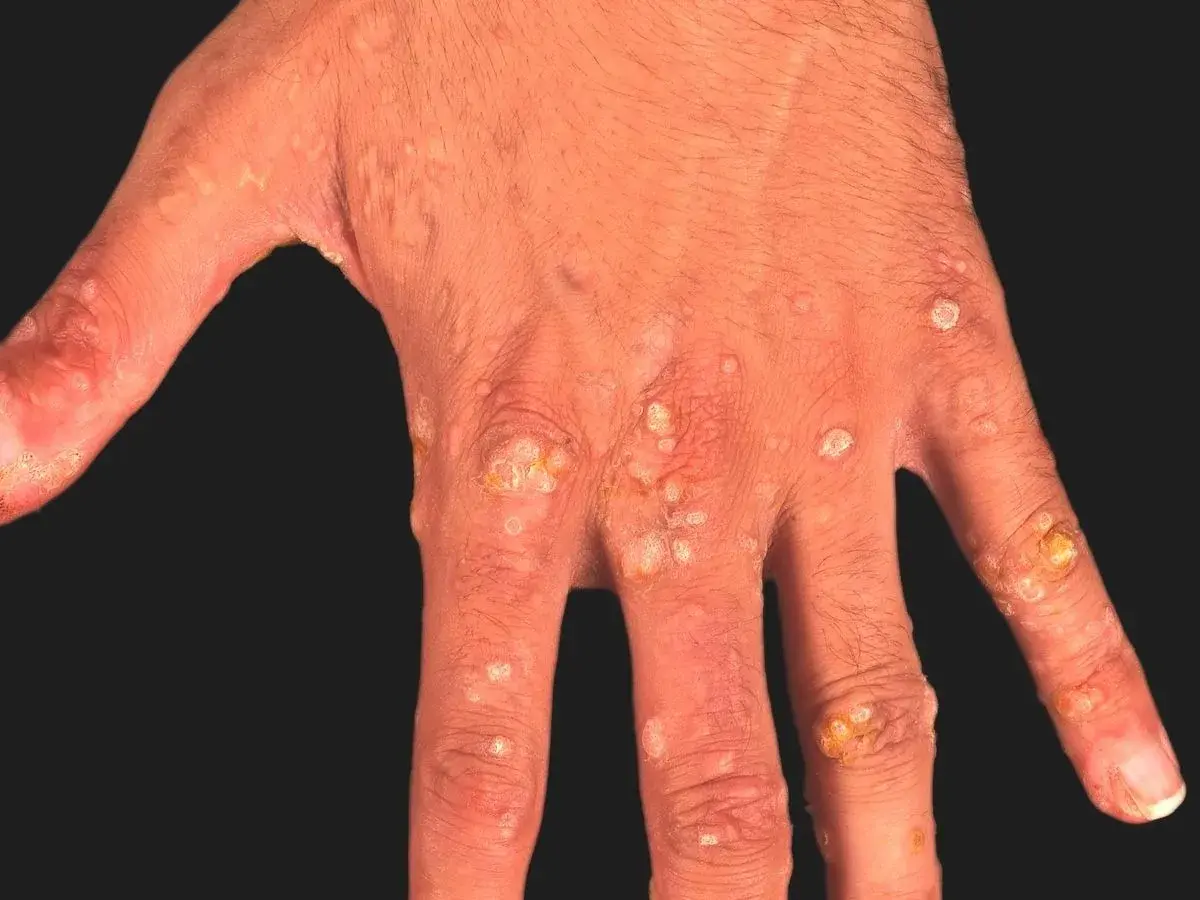 Hand med utslag av epidermodysplasia verruciformis. Många små, ljusa och mörkare fläckar samt knottror på fingrar och handrygg.