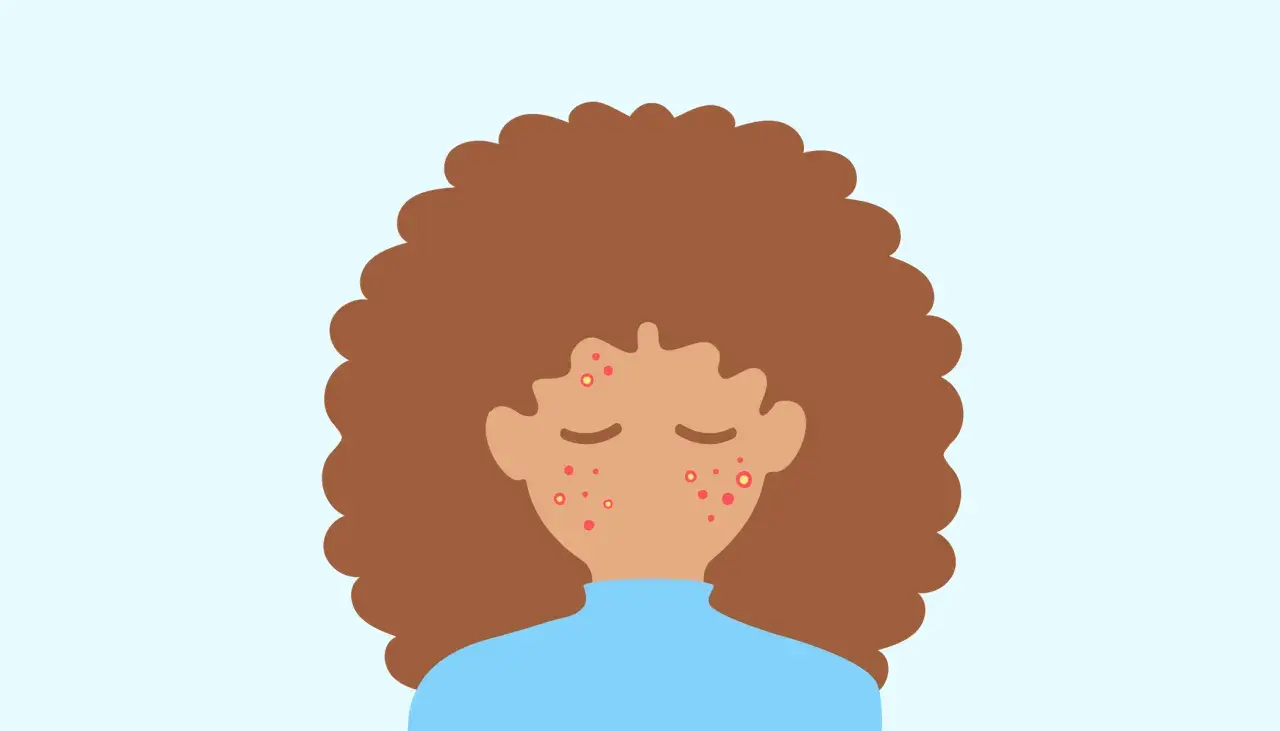En illustration av en person med lockigt brunt hår och en blå tröja. Ansiktet har flera röda prickar, vilket indikerar finne under huden.