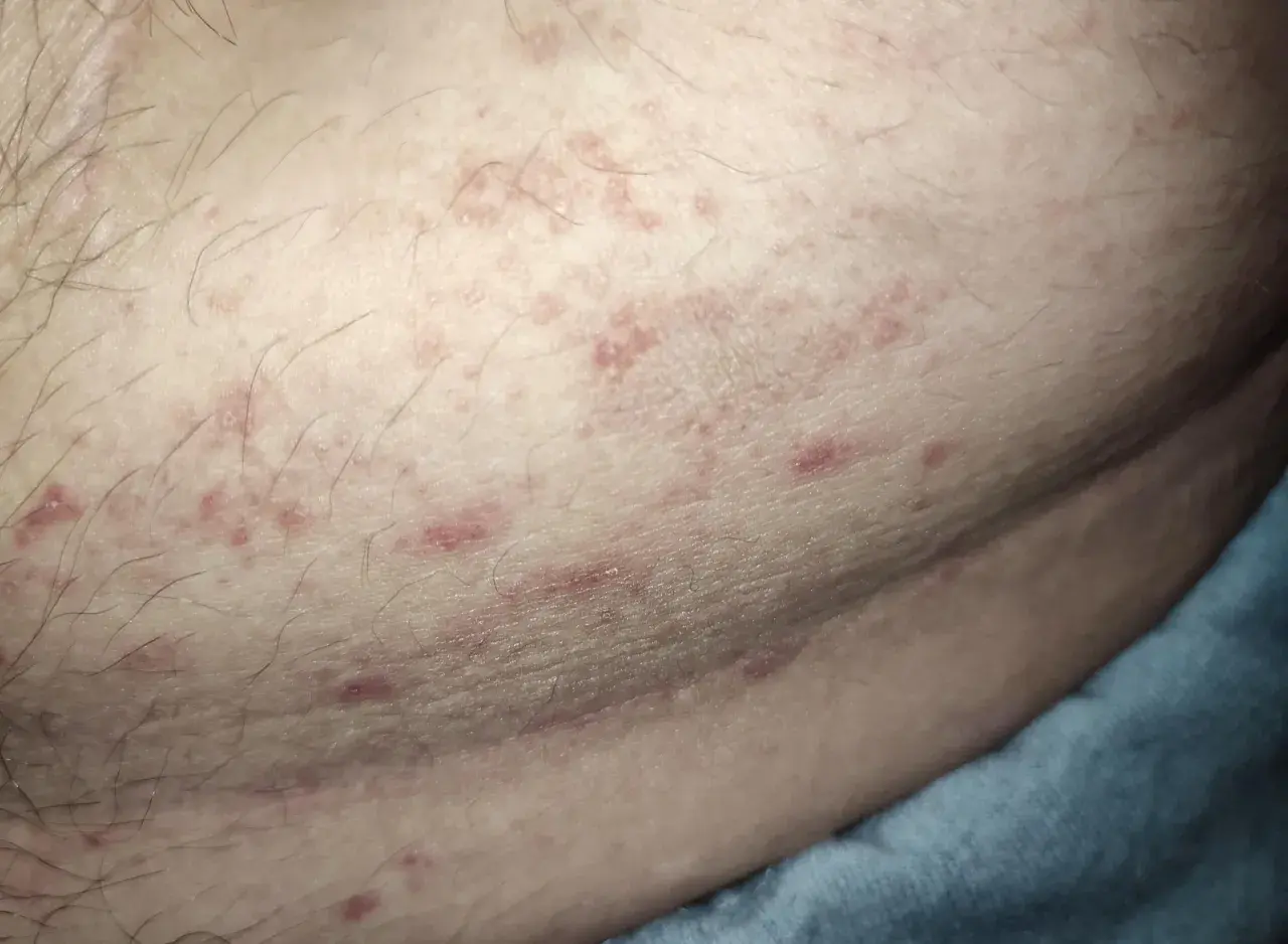 Hud med små röda prickar och utslag, möjligen relaterat till hiv.