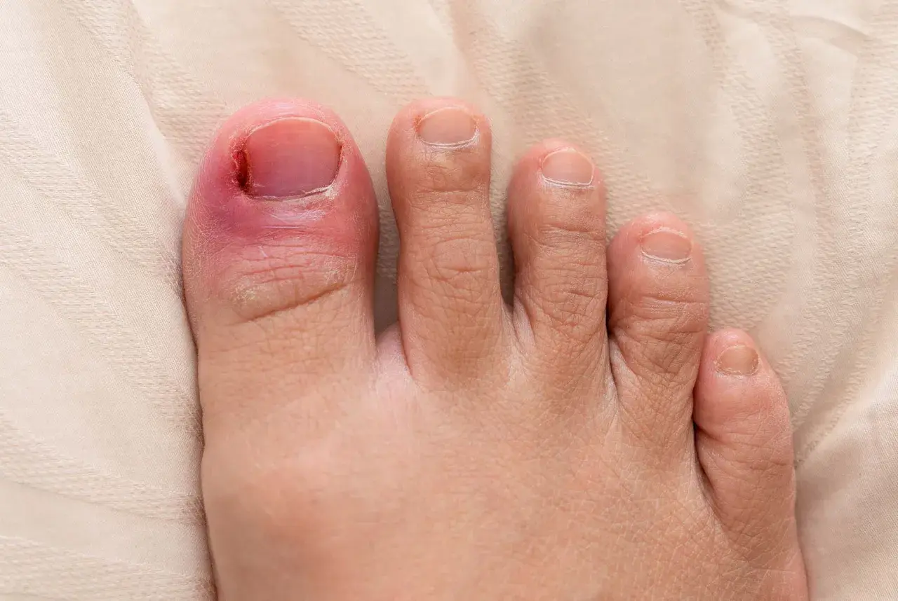 En inflammerad stortå med rodnad och svullnad runt nageln, vilket indikerar behov av nageltrång behandling.