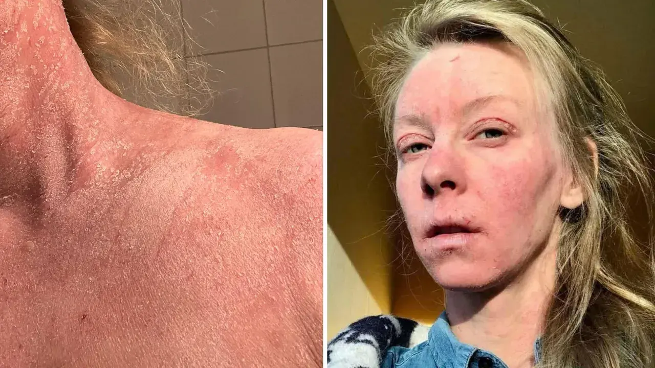 Bilden visar en person med svår hudirritation, fjällande hud på nacken och axlarna, samt rodnad och sår på ansiktet. Detta kan vara relaterat till användning av kortison och alkohol.