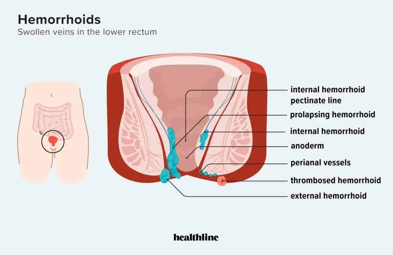 Illustration som visar hur ser hemorrojder ut, med interna och externa varianter samt blodproppsbildning i &auml;ndtarmen.