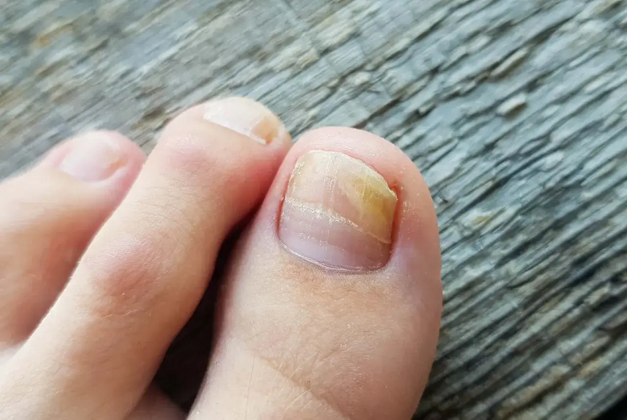 Tånagel med gulaktig missfärgning och förtjockning, tecken på nagelsvamp. Läs mer på 1177.