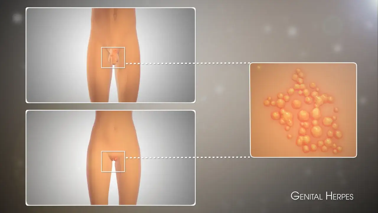 Illustration av herpes i underlivet, med n&auml;rbilder p&aring; utslag p&aring; manliga och kvinnliga k&ouml;nsorgan samt en detaljerad bild av viruspartiklar.