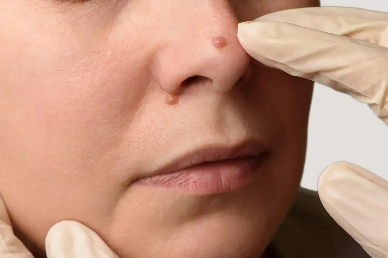 N&auml;rbild p&aring; en persons n&auml;sa med v&aring;rtliknande utv&auml;xter, m&ouml;jligen relaterade till epidermodysplasia verruciformis.