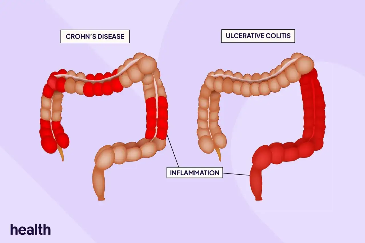 Illustration visar inflammation vid crohns sjukdom i olika delar av tarmen, j&auml;mf&ouml;rt med ulcer&ouml;s kolit.