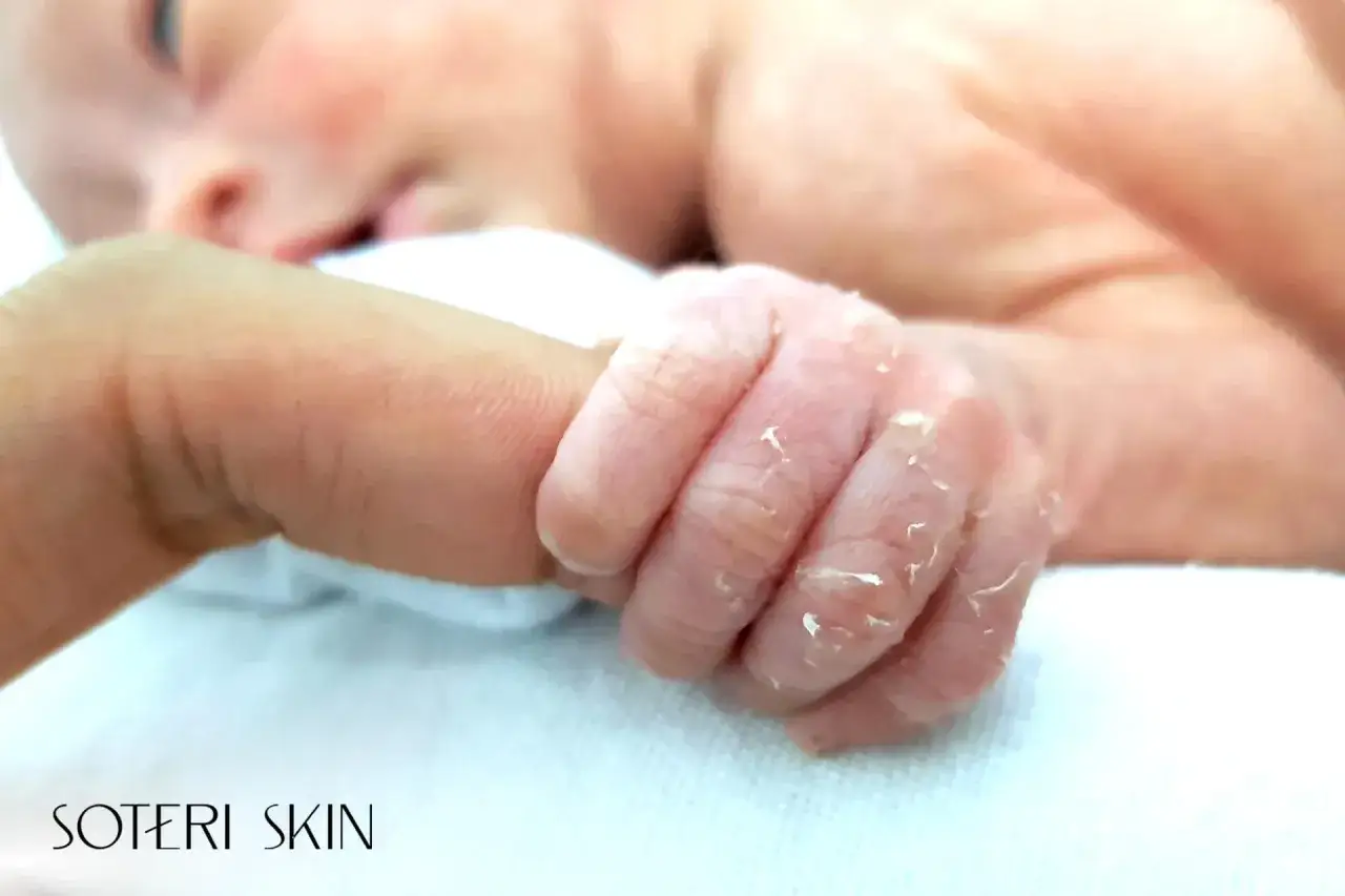 En bebis hand med torr hud som flagnar. En liten hand som håller i ett finger.