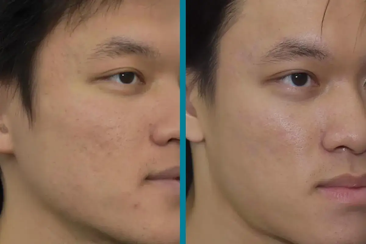F&ouml;re- och efterbilder visar hur dermapen behandling minskar synligheten av acne&auml;rr p&aring; en mans ansikte.