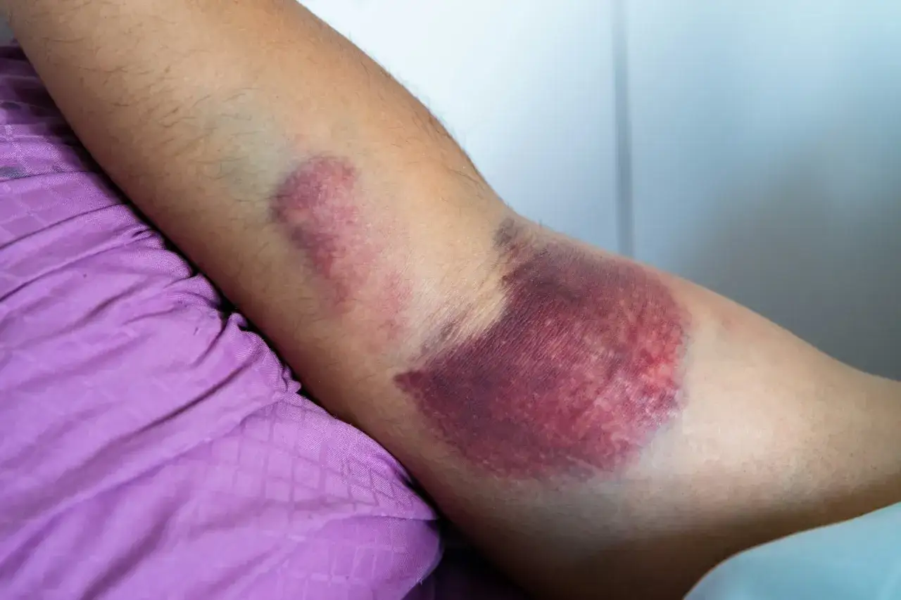 En arm med en stor, m&ouml;rklila kontusion som visar hur ett slag kan orsaka bl&aring;nad.