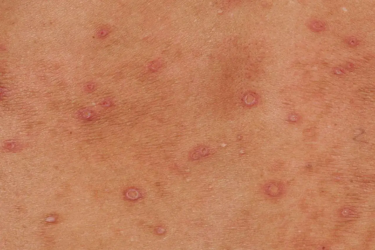 Hud med utslag, sm&aring; r&ouml;da prickar och ringformade lesioner. Kan vara ett tecken p&aring; hiv.