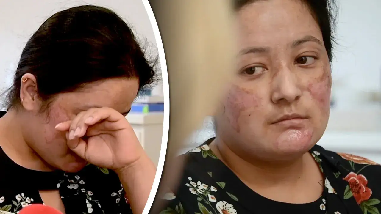 Kvinna med rodnad och irritation i ansiktet efter derma peeling. Hon ser ledsen ut och torkar en t&aring;r.