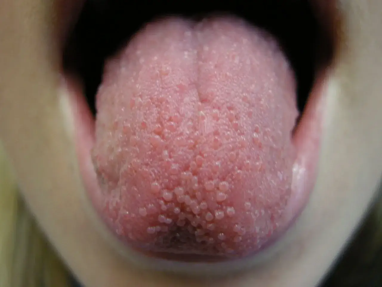 N&auml;rbild p&aring; en tunga med sm&aring; knottror, som kan vara tecken p&aring; munherpes inne i munnen.
