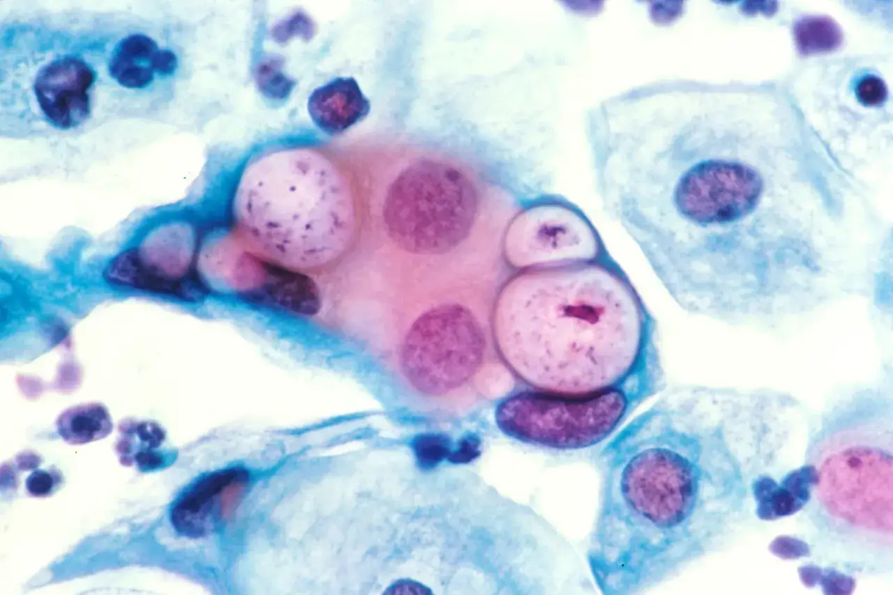 Mikroskopisk bild av celler, vissa med prickiga k&auml;rnor. Kan ge ledtr&aring;dar om hur man f&aring;r klamydia.