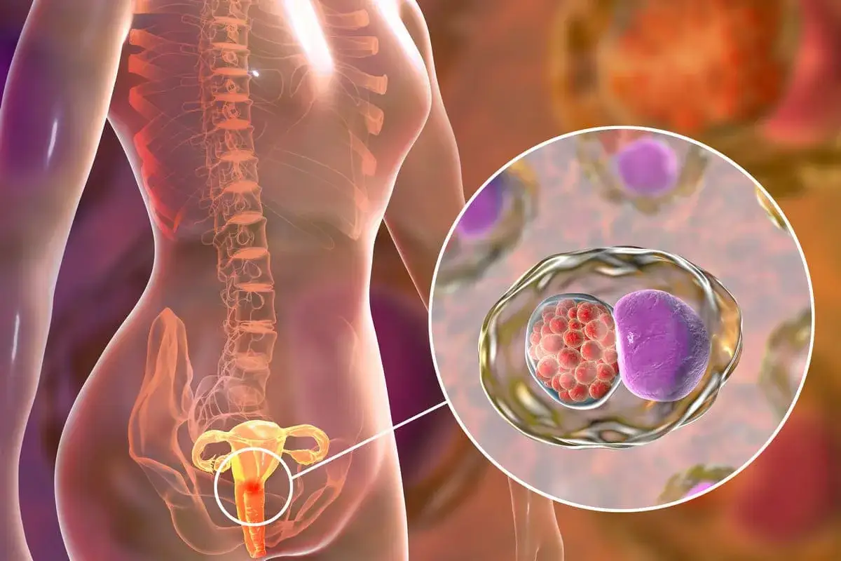 Illustration av kvinnans reproduktionsorgan och klamydiabakterier. Klamydia kan leda till sterilitet.