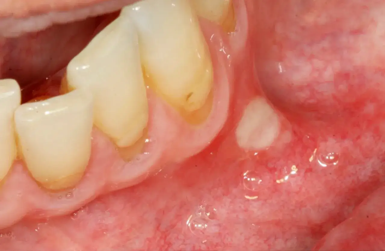 Vita fl&auml;ckar syns i munnen, m&ouml;jligen tecken p&aring; svamp i munnen (candidiasis).