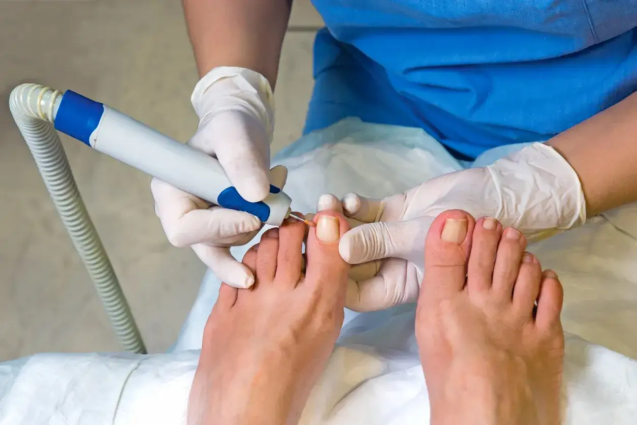 Professionell nageltr&aring;ng behandling utf&ouml;rs med ett roterande instrument.
