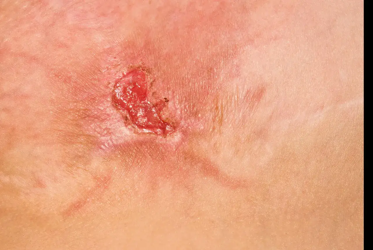Närbild på en infekterad hudskada med rodnad och sårskorpa, potentiella mrsa symtom.