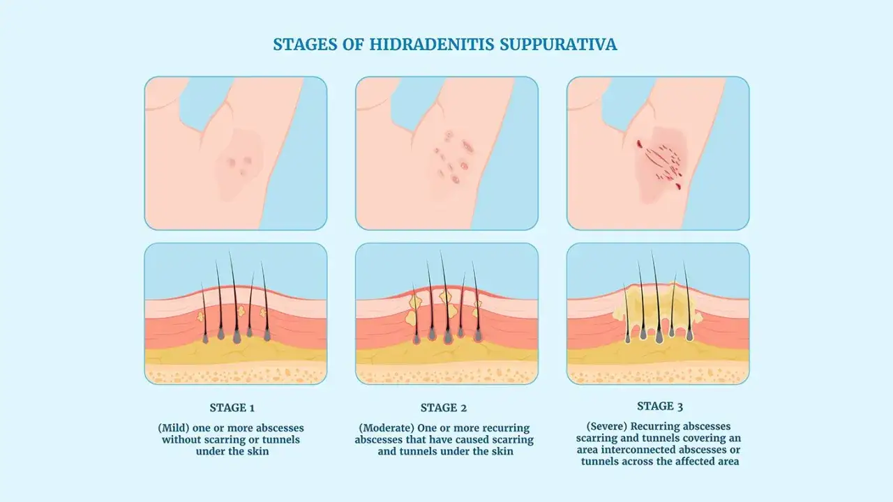 Illustration visar stadier av hidradenitis suppurativa, fr&aring;n milda abscesser till sv&aring;ra, &auml;rrade omr&aring;den med tunnlar.